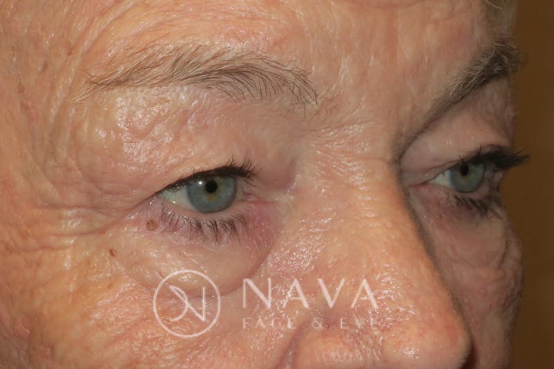 Ptosis Repair Before & After Gallery - Patient 147616640 - Image 3