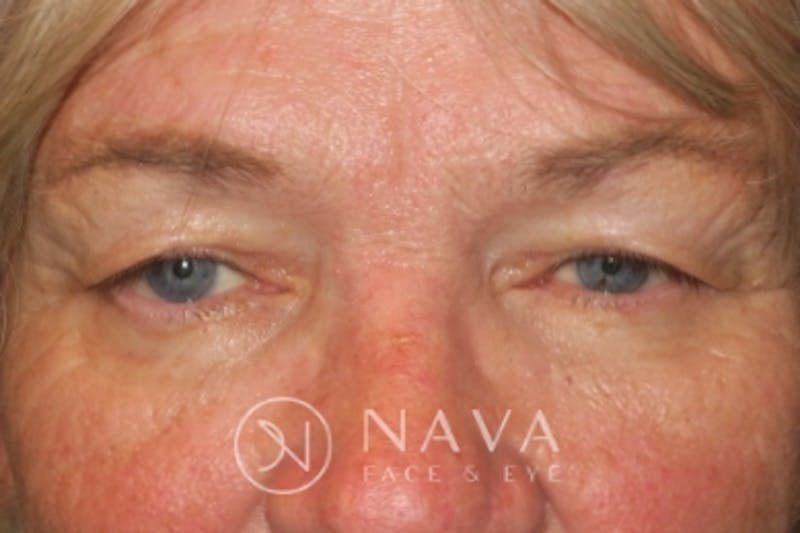 Ptosis Repair Before & After Gallery - Patient 147616639 - Image 1