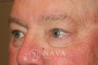 Ptosis Repair Before & After Gallery - Patient 147616570 - Image 6
