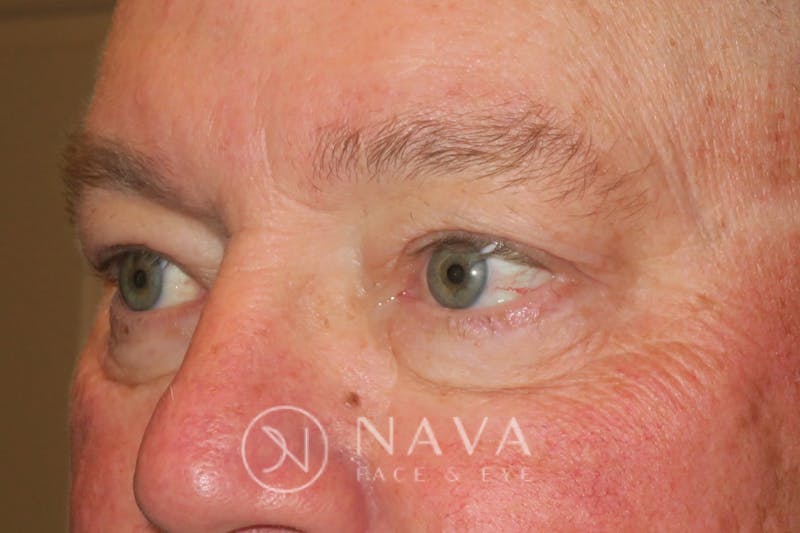 Ptosis Repair Before & After Gallery - Patient 147616570 - Image 6