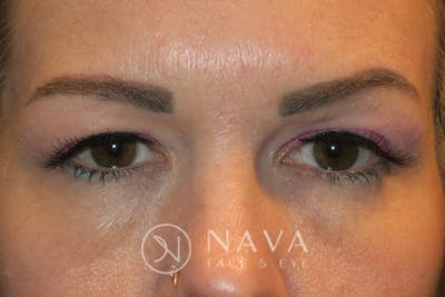 Ptosis Repair Before & After Gallery - Patient 147616557 - Image 1