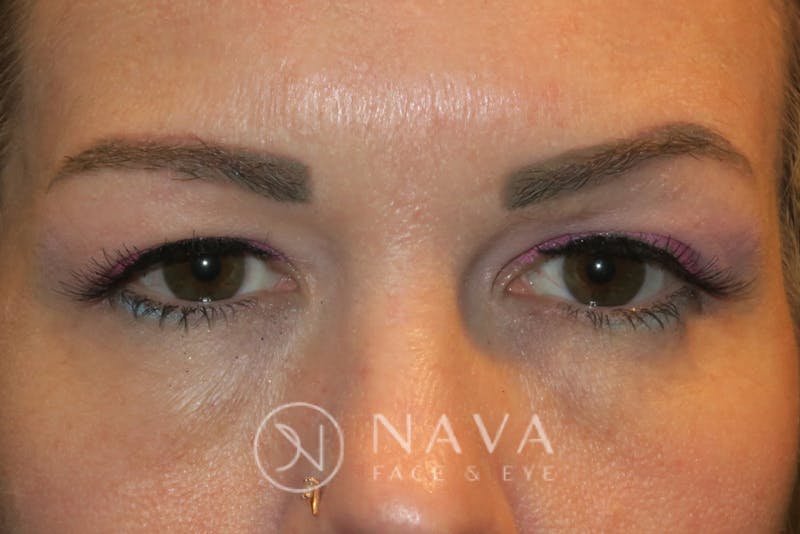 Browplasty (Brow Lift) Before & After Gallery - Patient 147616558 - Image 1