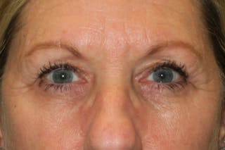 Ptosis Repair Before & After Gallery - Patient 147616641 - Image 2