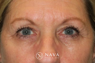Ptosis Repair Before & After Gallery - Patient 147616641 - Image 2