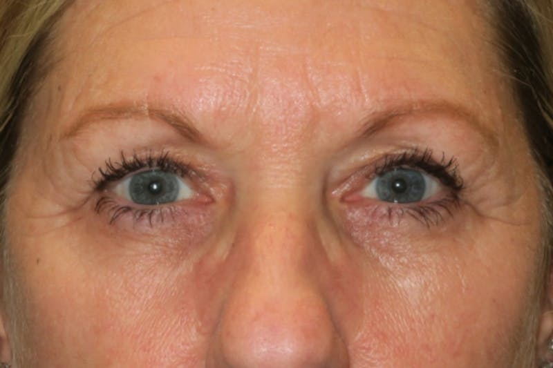 Ptosis Repair Before & After Gallery - Patient 147616641 - Image 2