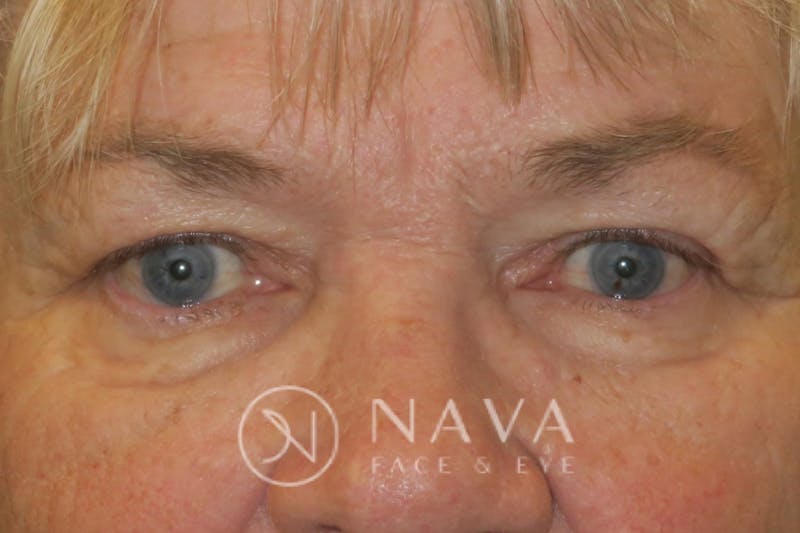 Ptosis Repair Before & After Gallery - Patient 147616639 - Image 2