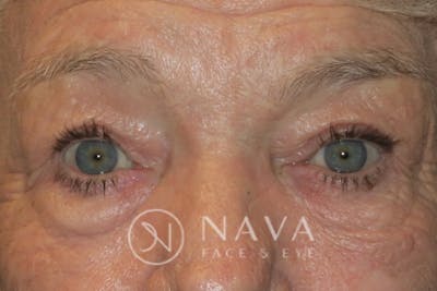 Ptosis Repair Before & After Gallery - Patient 147616640 - Image 2