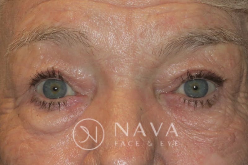 Ptosis Repair Before & After Gallery - Patient 147616640 - Image 2