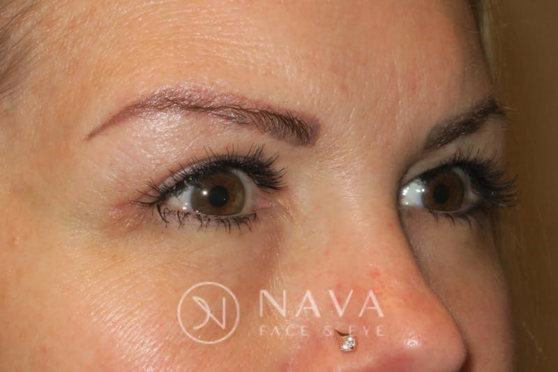Browplasty (Brow Lift) Before & After Gallery - Patient 147616558 - Image 4