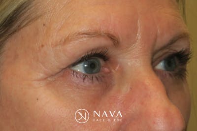 Ptosis Repair Before & After Gallery - Patient 147616641 - Image 4