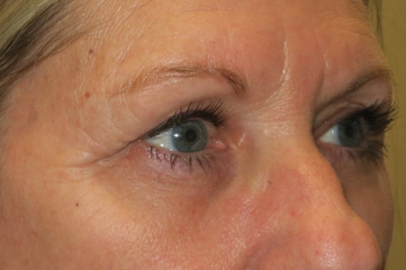 Ptosis Repair Before & After Gallery - Patient 147616641 - Image 4