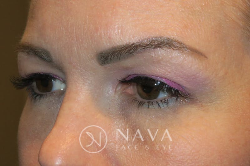 Browplasty (Brow Lift) Before & After Gallery - Patient 147616558 - Image 5