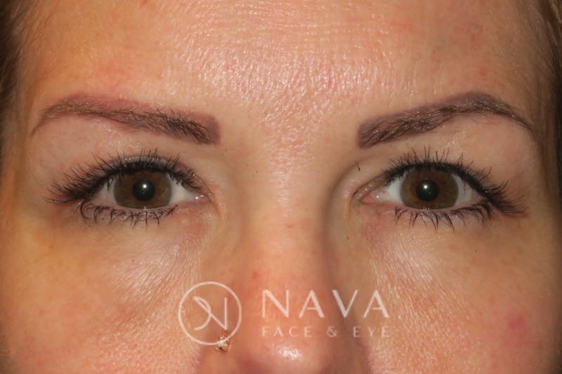 Ptosis Repair Before & After Gallery - Patient 147616557 - Image 2
