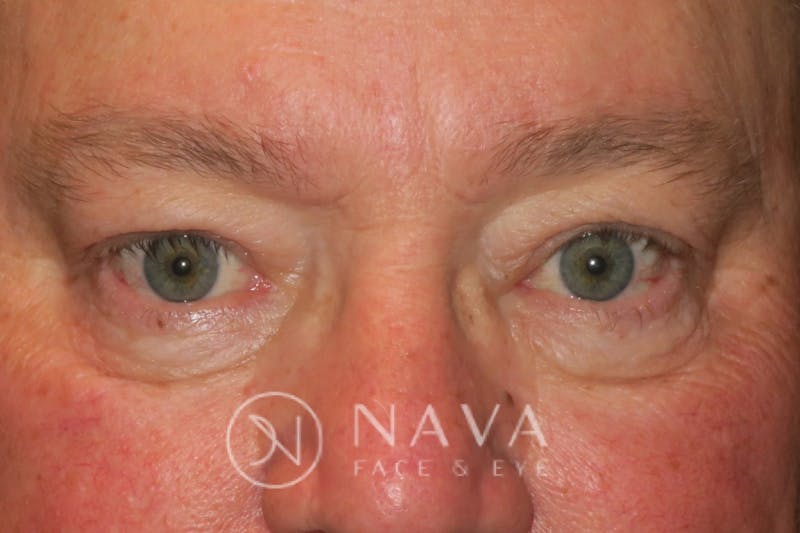 Ptosis Repair Before & After Gallery - Patient 147616570 - Image 2
