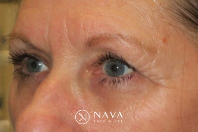 Ptosis Repair Before & After Gallery - Patient 147616641 - Image 6