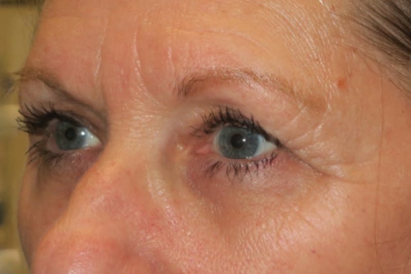 Ptosis Repair Before & After Gallery - Patient 147616641 - Image 6