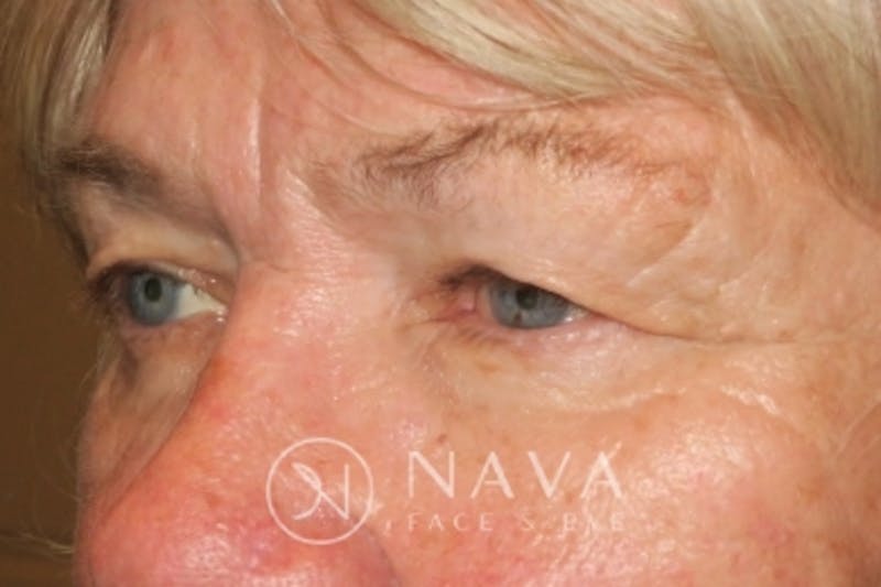 Ptosis Repair Before & After Gallery - Patient 147616639 - Image 5