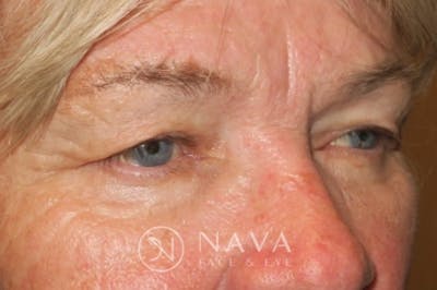 Ptosis Repair Before & After Gallery - Patient 147616639 - Image 3