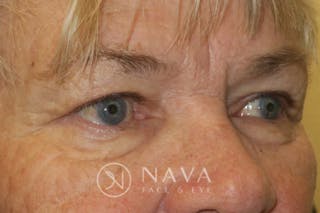 Ptosis Repair Before & After Gallery - Patient 147616639 - Image 4
