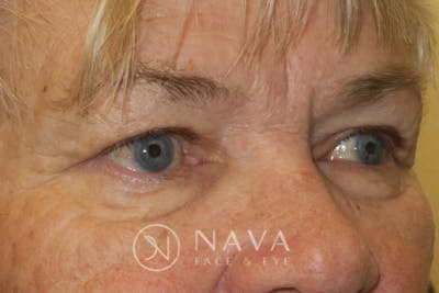 Ptosis Repair Before & After Gallery - Patient 147616639 - Image 4