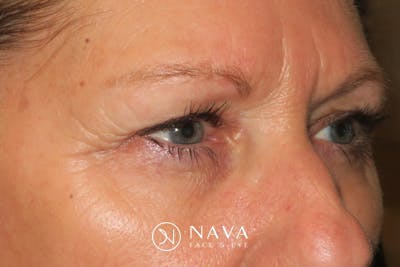 Ptosis Repair Before & After Gallery - Patient 147616641 - Image 3