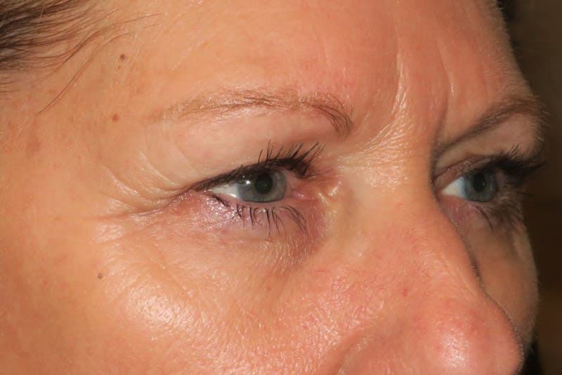 Ptosis Repair Before & After Gallery - Patient 147616641 - Image 3