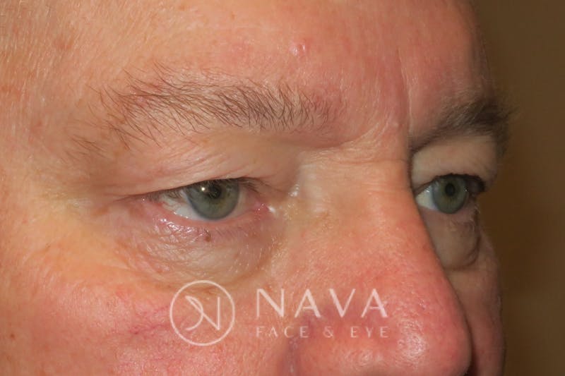 Ptosis Repair Before & After Gallery - Patient 147616570 - Image 3