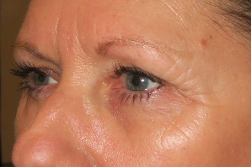 Ptosis Repair Before & After Gallery - Patient 147616641 - Image 5