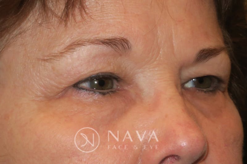 Ptosis Repair Before & After Gallery - Patient 147616576 - Image 3