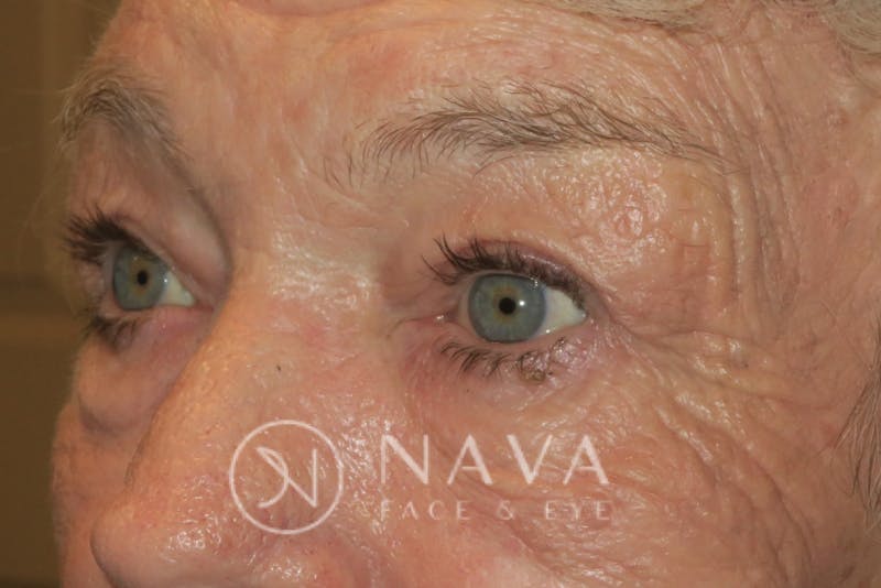 Ptosis Repair Before & After Gallery - Patient 147616640 - Image 6
