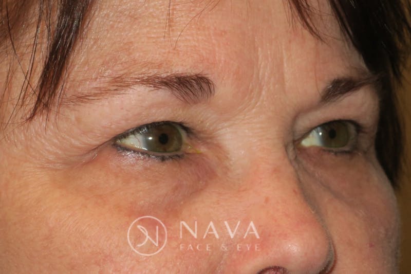 Ptosis Repair Before & After Gallery - Patient 147616576 - Image 4