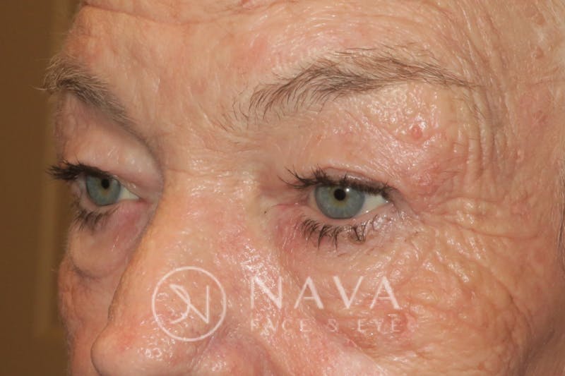 Ptosis Repair Before & After Gallery - Patient 147616640 - Image 5