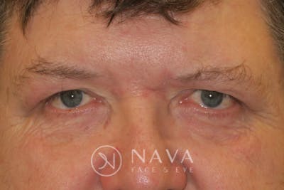 Upper Blepharoplasty (Upper Eyelid Surgery) Before & After Gallery - Patient 147616646 - Image 2