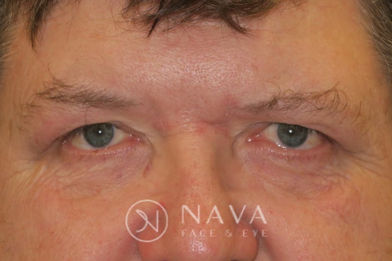 Upper Blepharoplasty (Upper Eyelid Surgery) Before & After Gallery - Patient 147616646 - Image 2