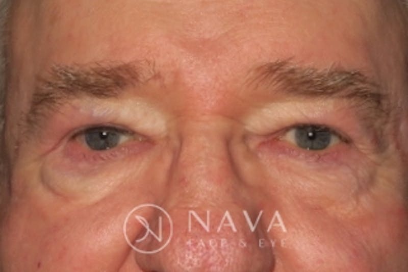 Upper Blepharoplasty (Upper Eyelid Surgery) Before & After Gallery - Patient 147616645 - Image 2