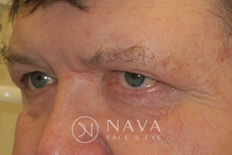 Upper Blepharoplasty (Upper Eyelid Surgery) Before & After Gallery - Patient 147616646 - Image 6
