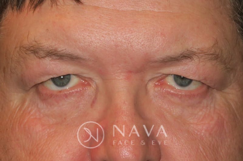 Upper Blepharoplasty (Upper Eyelid Surgery) Before & After Gallery - Patient 147616646 - Image 1