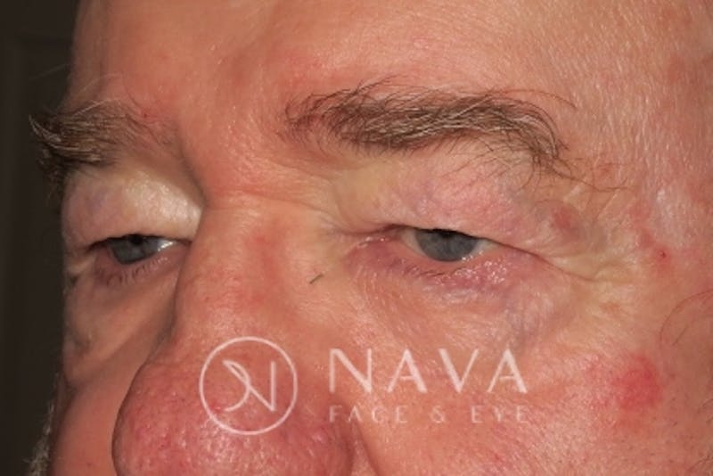 Upper Blepharoplasty (Upper Eyelid Surgery) Before & After Gallery - Patient 147616645 - Image 5