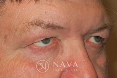 Upper Blepharoplasty (Upper Eyelid Surgery) Before & After Gallery - Patient 147616646 - Image 3