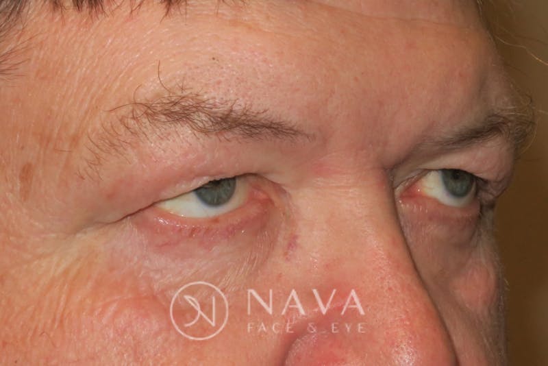 Upper Blepharoplasty (Upper Eyelid Surgery) Before & After Gallery - Patient 147616646 - Image 3