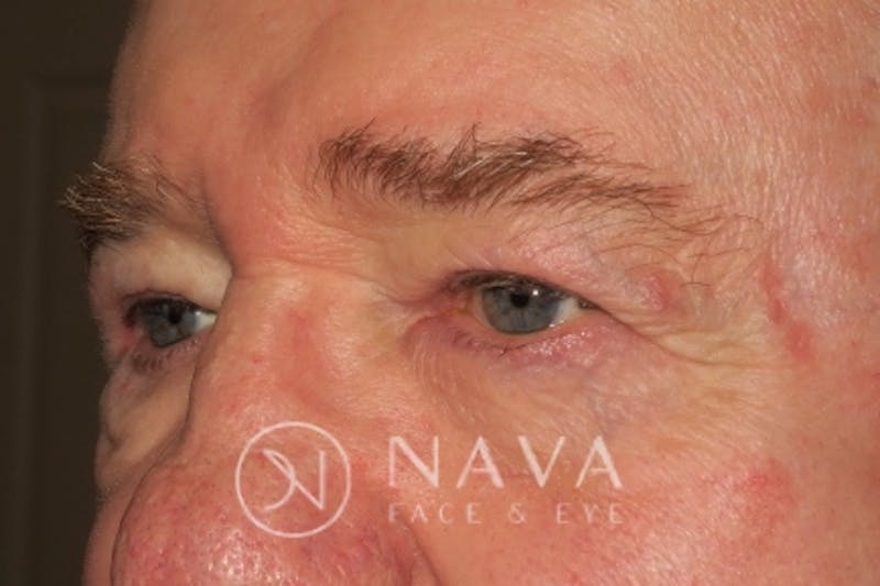 Upper Blepharoplasty (Upper Eyelid Surgery) Before & After Gallery - Patient 147616645 - Image 6