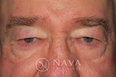 Upper Blepharoplasty (Upper Eyelid Surgery) Before & After Gallery - Patient 147616645 - Image 1