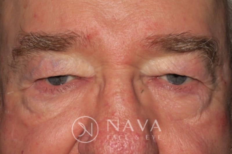 Upper Blepharoplasty (Upper Eyelid Surgery) Before & After Gallery - Patient 147616645 - Image 1