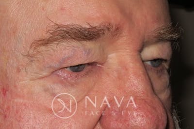 Upper Blepharoplasty (Upper Eyelid Surgery) Before & After Gallery - Patient 147616645 - Image 3