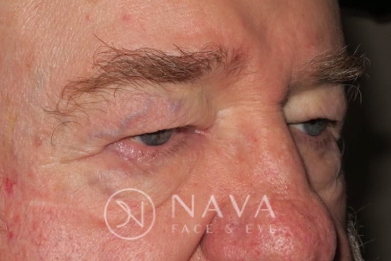 Upper Blepharoplasty (Upper Eyelid Surgery) Before & After Gallery - Patient 147616645 - Image 3
