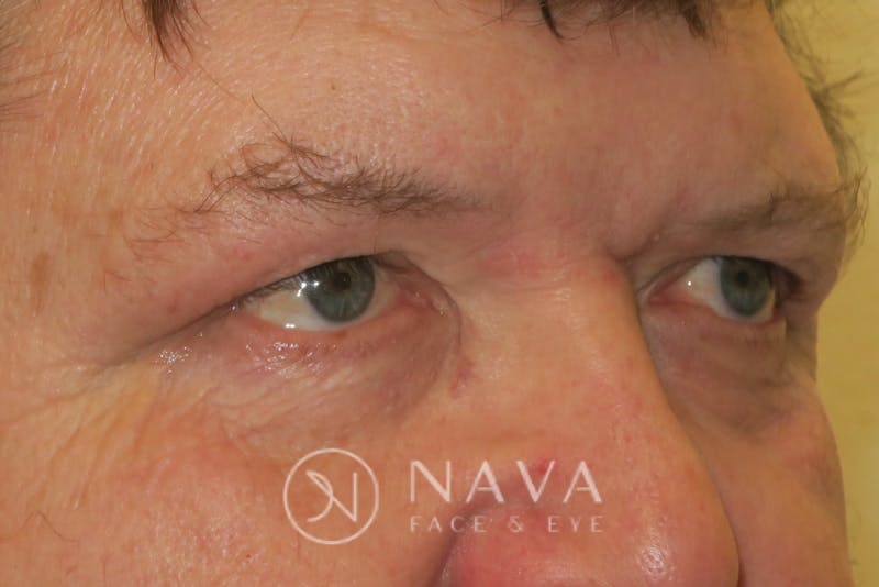 Upper Blepharoplasty (Upper Eyelid Surgery) Before & After Gallery - Patient 147616646 - Image 4
