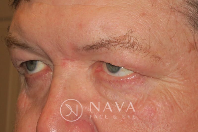 Upper Blepharoplasty (Upper Eyelid Surgery) Before & After Gallery - Patient 147616646 - Image 5