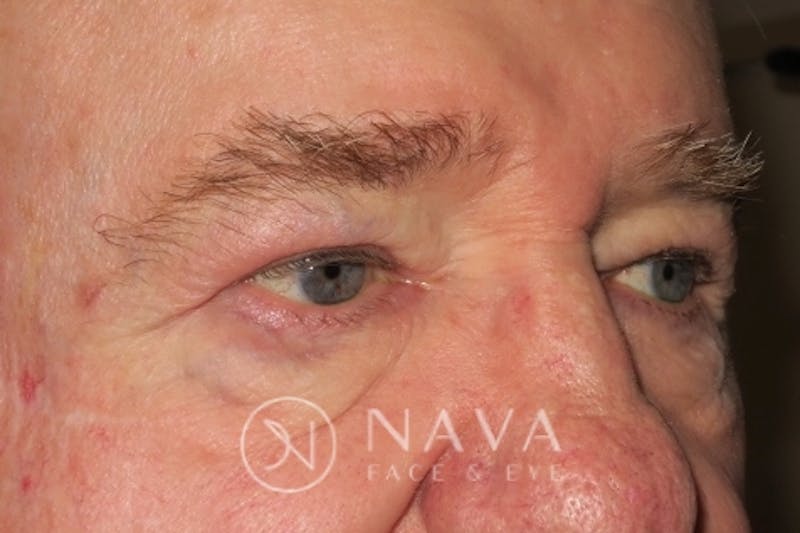 Upper Blepharoplasty (Upper Eyelid Surgery) Before & After Gallery - Patient 147616645 - Image 4