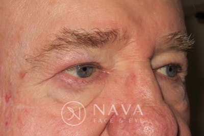 Upper Blepharoplasty (Upper Eyelid Surgery) Before & After Gallery - Patient 147616645 - Image 4
