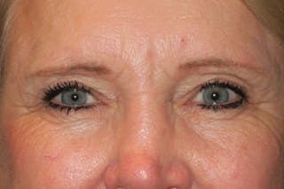 Upper Blepharoplasty (Upper Eyelid Surgery) Before & After Gallery - Patient 148992215 - Image 2